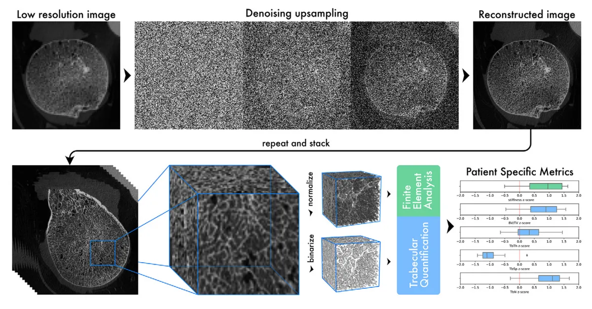 Method overview. Low-resolution sections from CT scans are upsampled and stacked to construct a detailed three-dimensional image. From this image, microstructural and mechanical characteristics of the trabecular bone are calculated, which can be used to describe a patient's bone health status. BV/TV = trabecular bone volume fraction, TbN = trabecular number, TbSp = trabecular separation, TbTh = trabecular thickness.