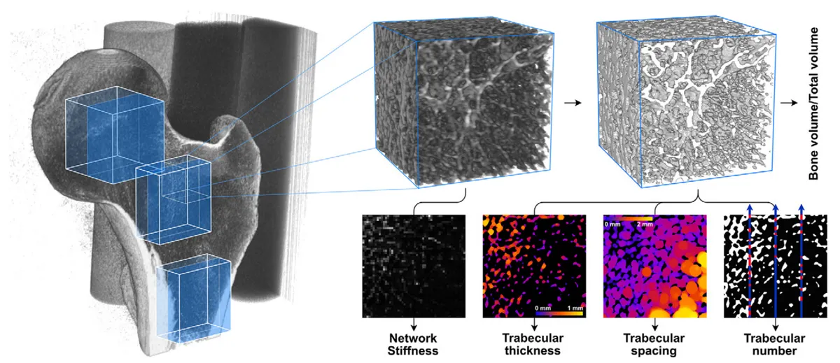 Sixteen regions of interest (eight femoral head, four neck, four upper shaft) were selected from each scan. The ImageJ library BoneJ was used to quantify four trabecular parameters, and a finite element solver was used to calculate trabecular network stiffness. Bone parameter maps at the bottom of the figure represent the following (from left to right): the strain energy of an axial section across the region, a trabecular thickness heatmap, a trabecular spacing heatmap, and an illustration of trabecular number.