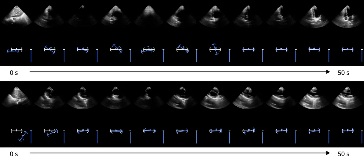 AP4C (top) and PLAX (bottom) views acquired with model guidance. At the start of sampling, the transducer is placed in a neutral position on the chest wall. The operator then attempts to align the reticle with the target to acquire the selected view.