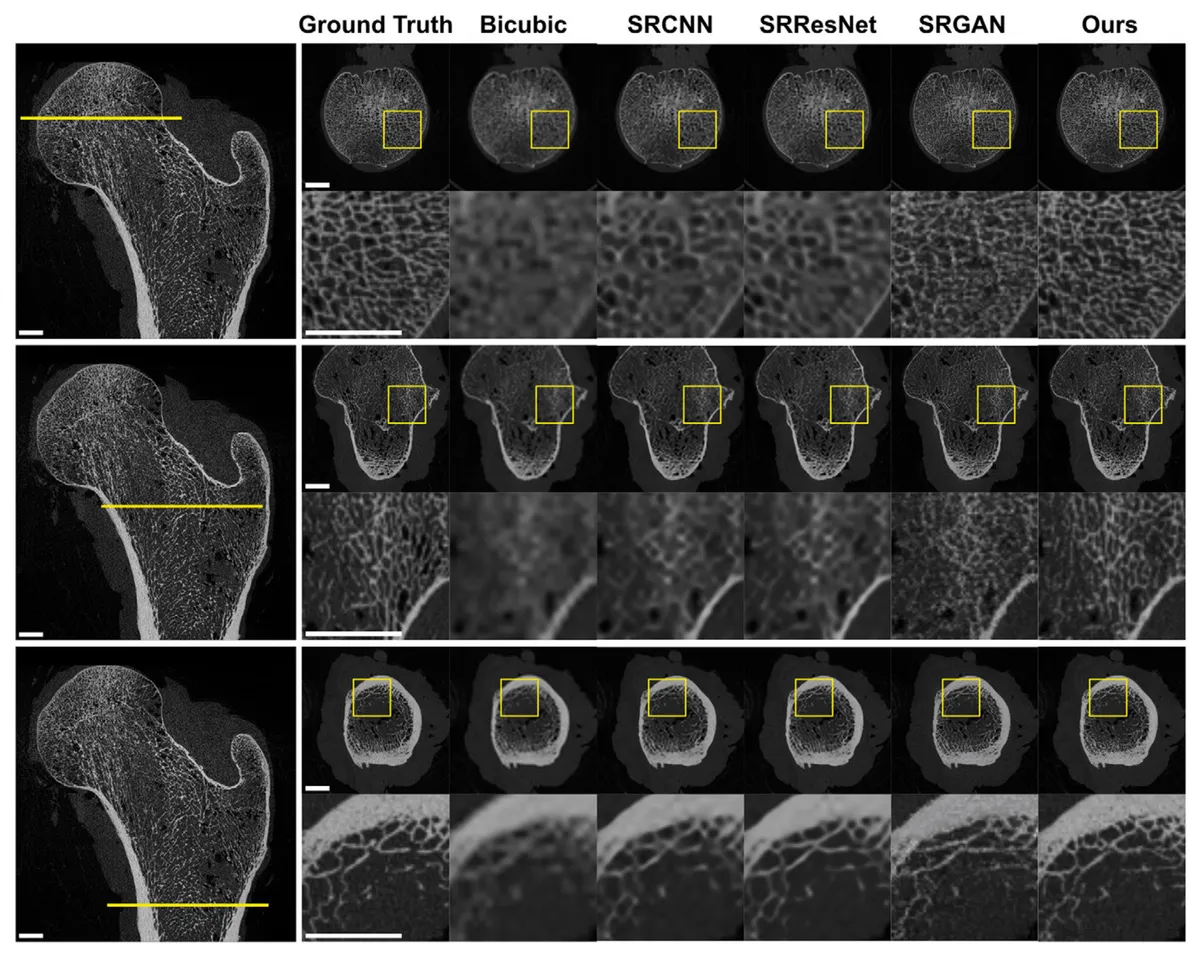 A qualitative comparison of several deep learning upsampling methods. Ground truth images and representative reconstructions are shown for the femoral head (upper row), greater trochanter (middle row), and upper shaft (bottom row). Enlarged views depicting detailed trabecular bone illustrate the texture-smoothing behavior of convolutional neural network–based models and the advantages of our method in preserving image sharpness and network connectivity. Scale bar is 1 cm. SRCNN = super-resolution convolutional neural network, SRGAN = super-resolution generative adversarial network, SRResNet = super-resolution ResNet.
